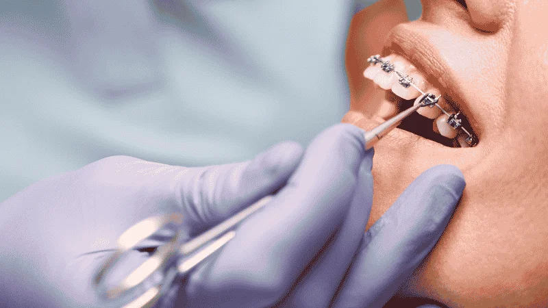 Limitations and When Braces or Surgery May Be Needed