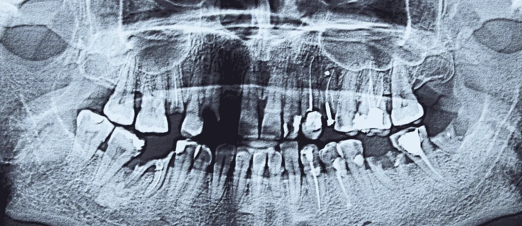 all on x dental implants candidates