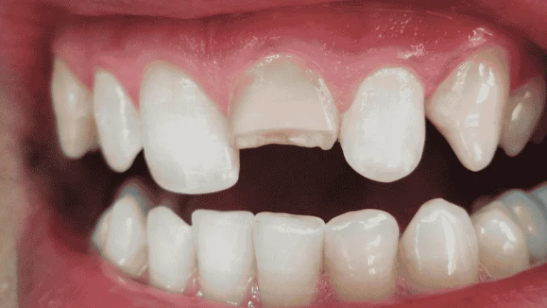 can a cracked tooth heal