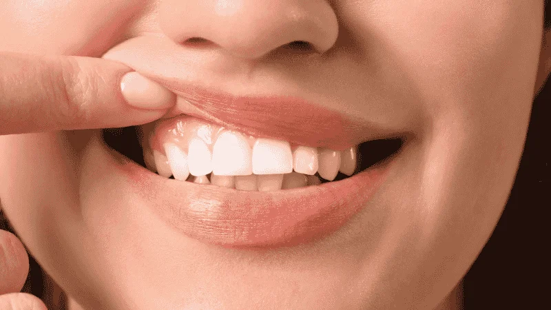 can gum recession be reversed