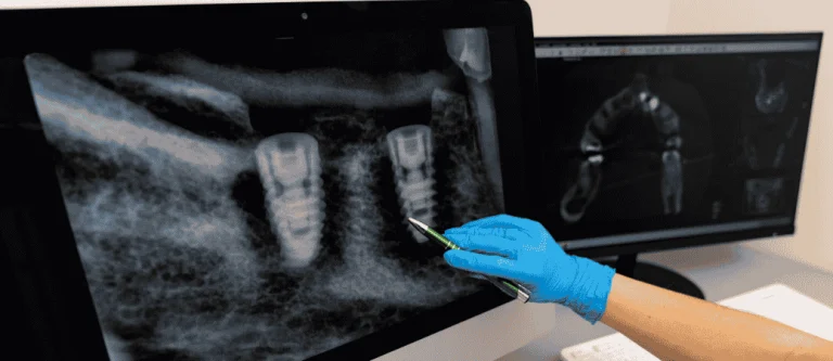 loose dental implant