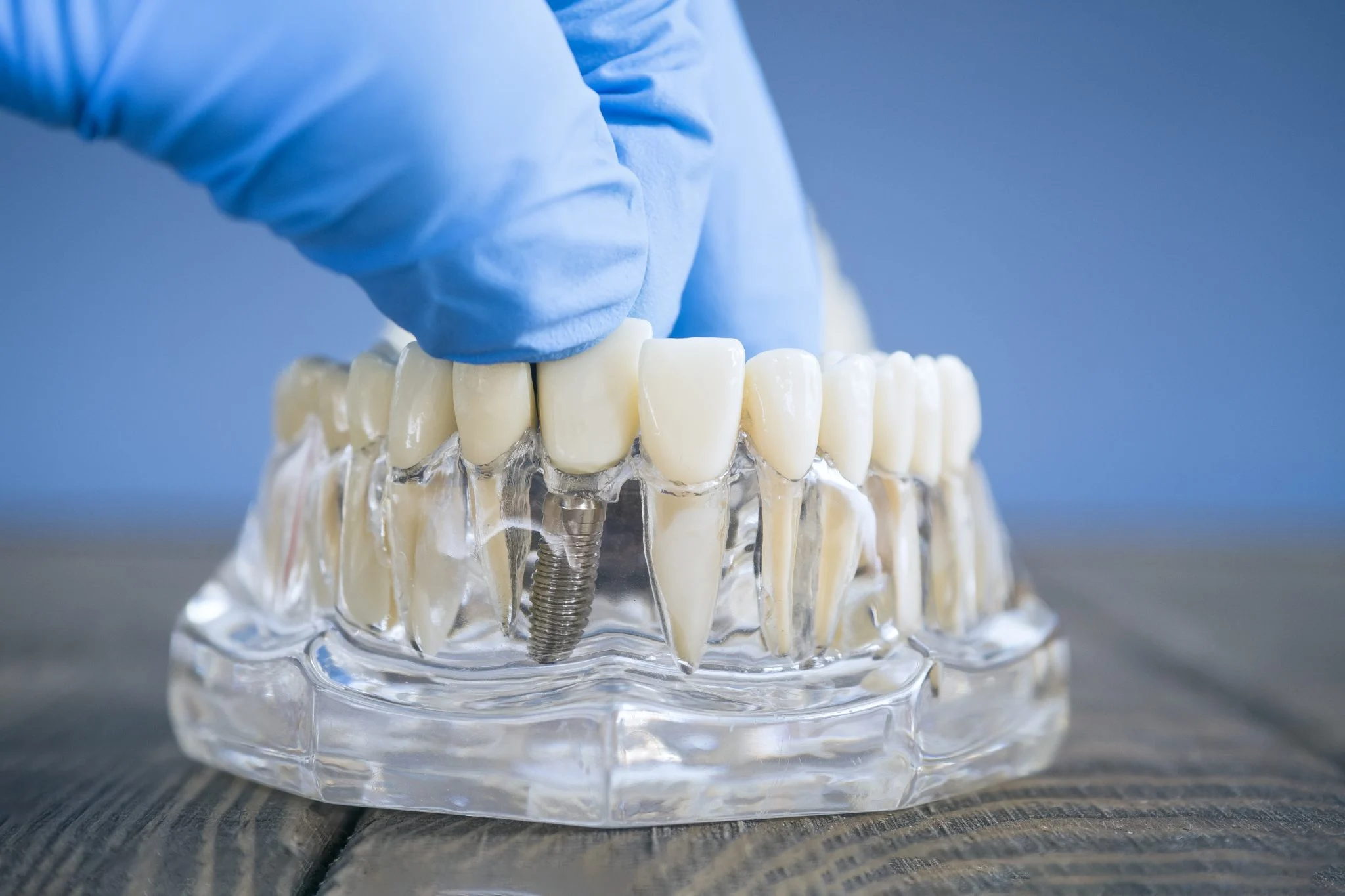 Side view of a dental implant model with a gloved hand