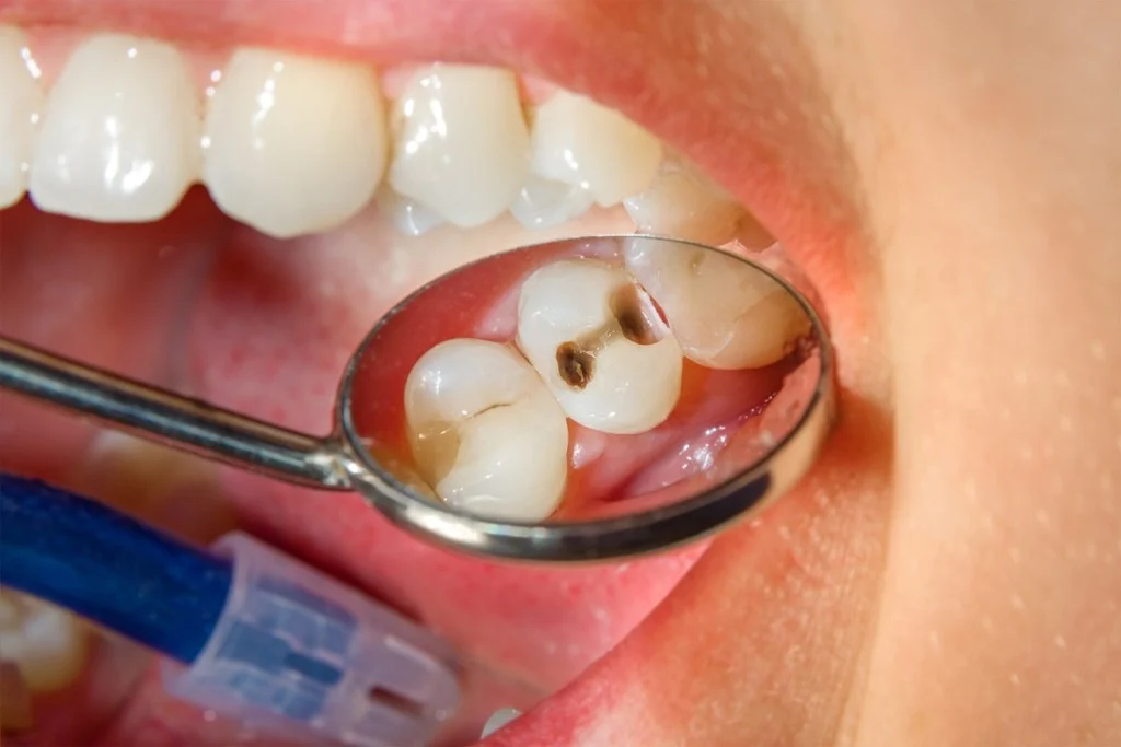 signs-your-dental-filling-needs-to-be-replaced_68a89b95e60ca