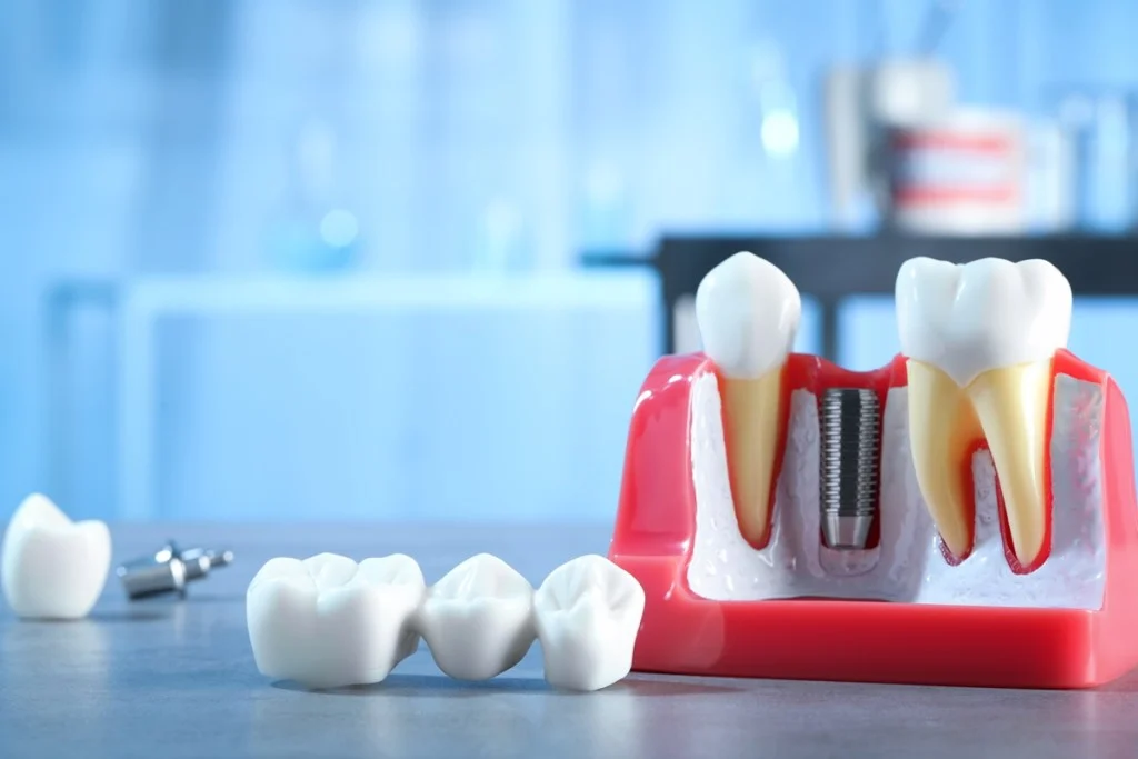 what-you-should-know-before-choosing-dental-implants-or-bridges_68a89b8775db6